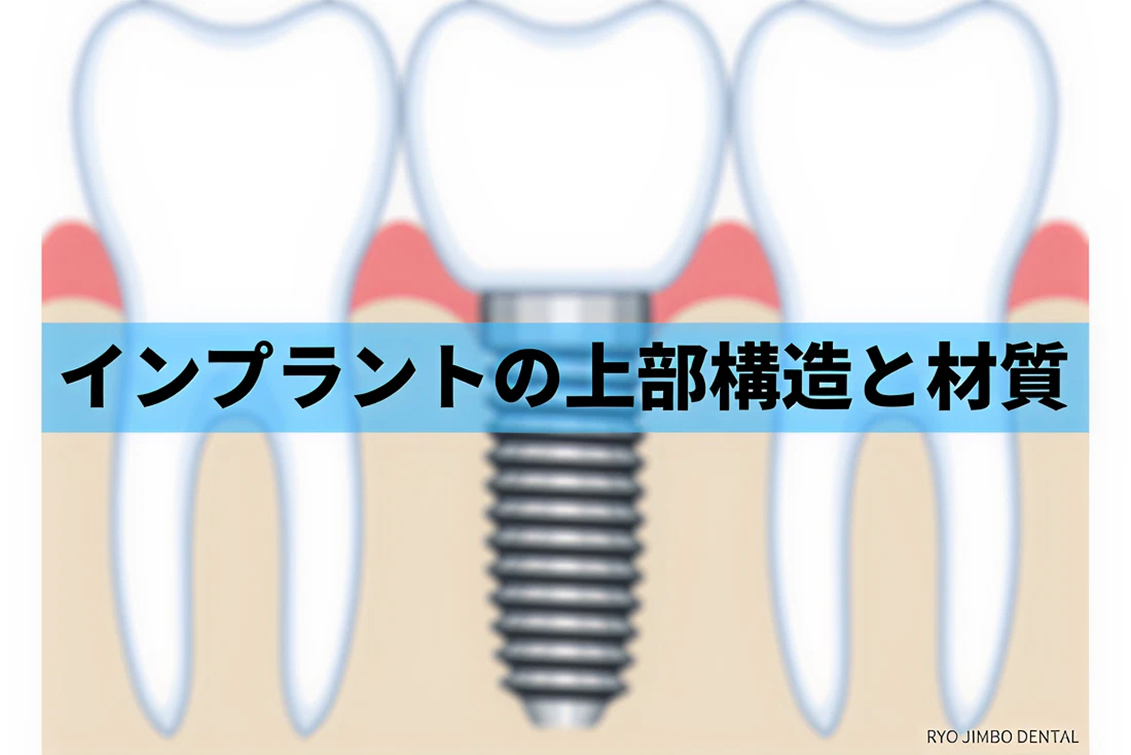 インプラント上部構造や材質について