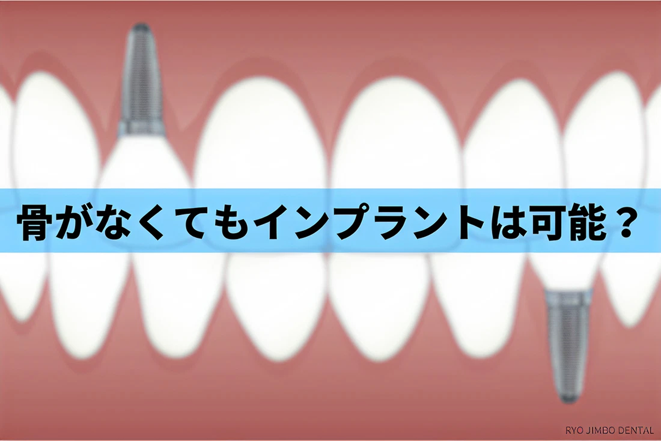 骨がない人でもインプラント治療はできるのか