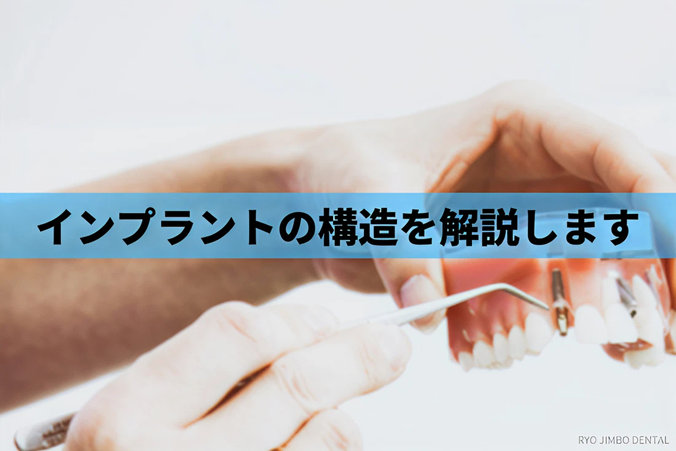 インプラントの構造をわかりやすく解説