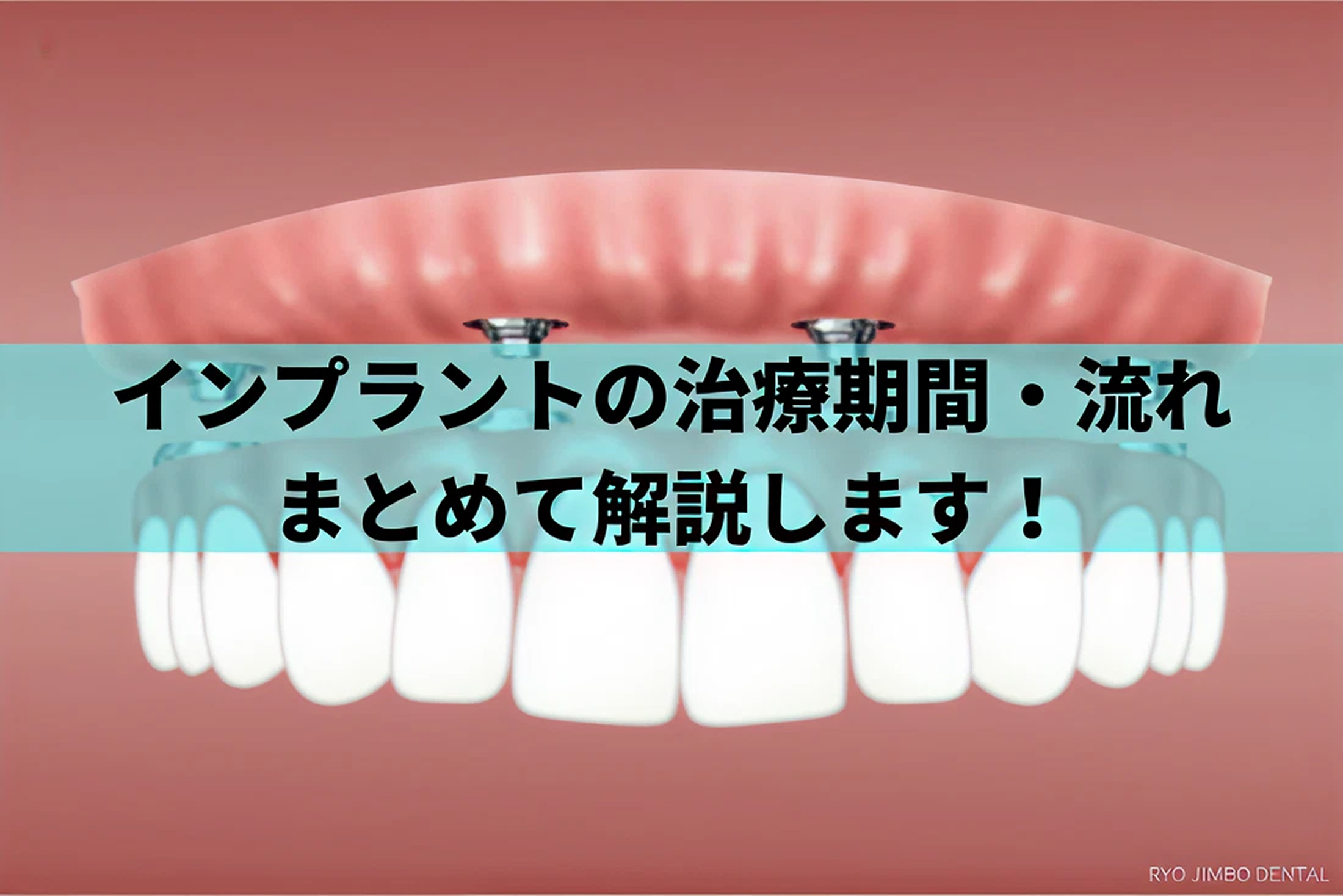 インプラント治療の期間や流れ、通院回数はどれくらい？