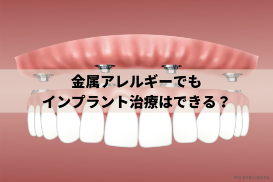 金属アレルギーでもインプラント治療は可能かを歯科医院が解説