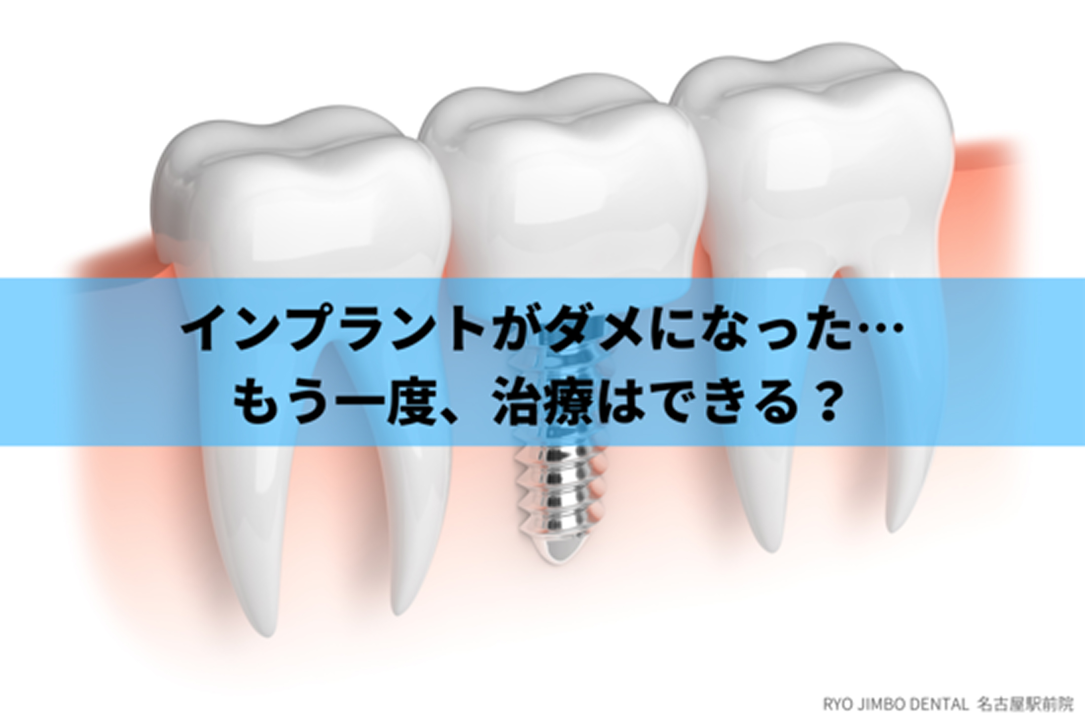 インプラントがダメになった場合の対処法｜寿命や再治療できるのかも解説