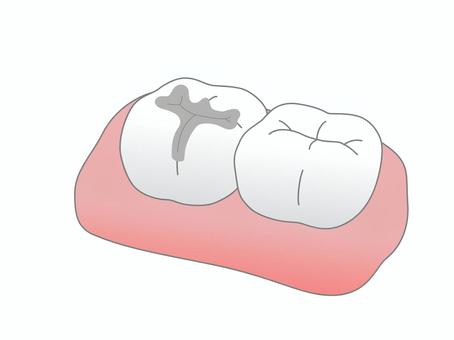 銀歯とセラミックの違いについて