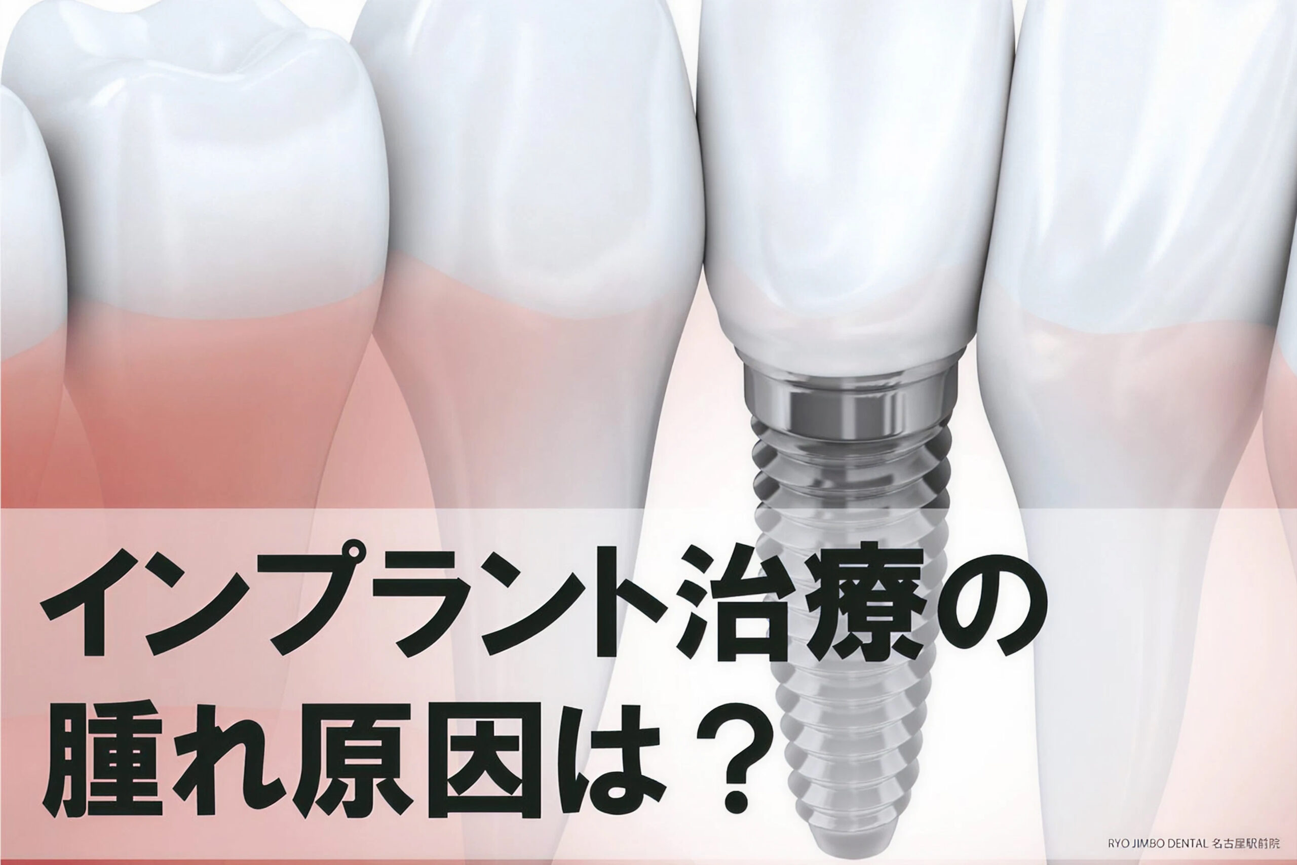 インプラント治療の腫れについて｜腫れる原因や痛み、対処法を解説