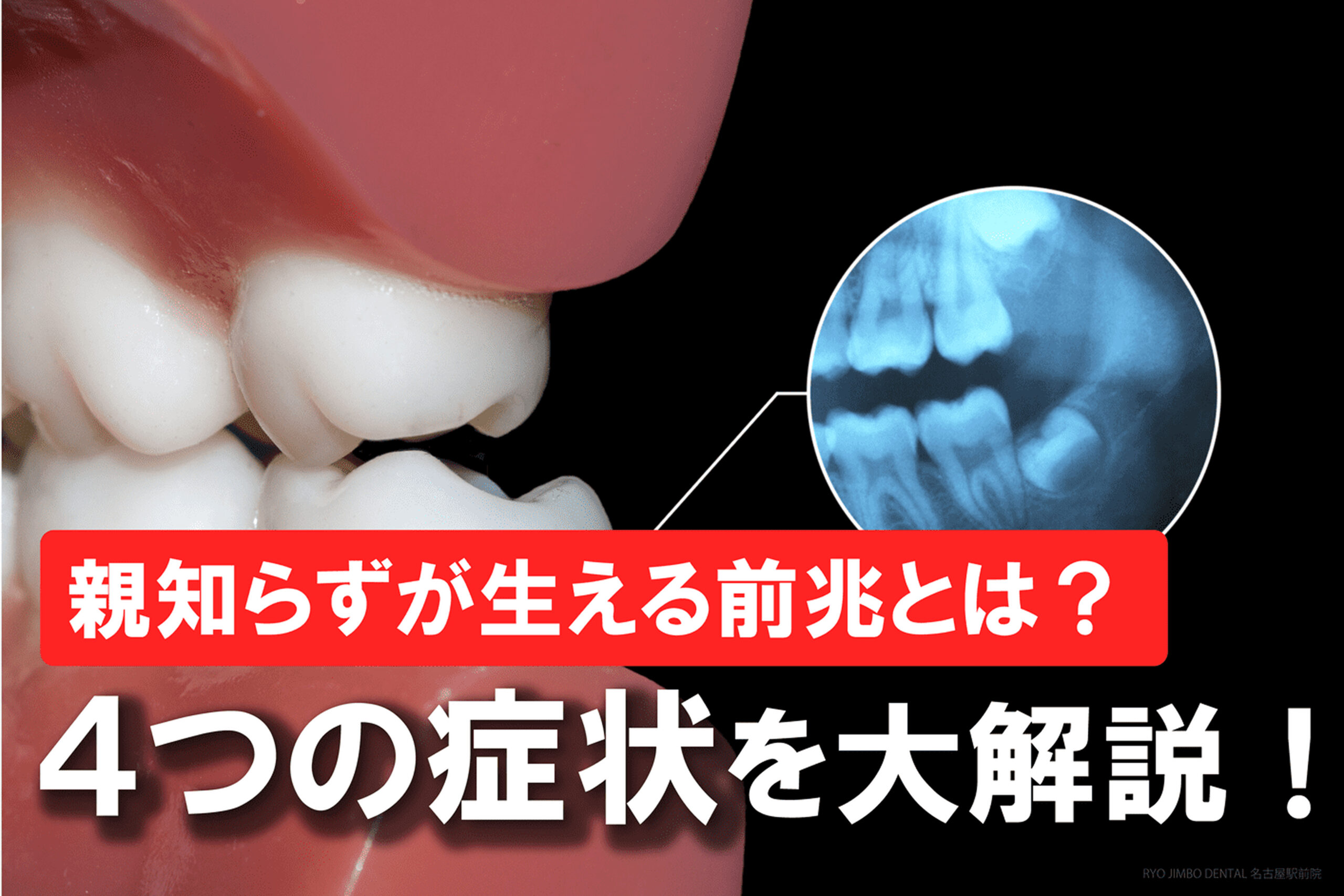 親知らずが生える前兆とは？
