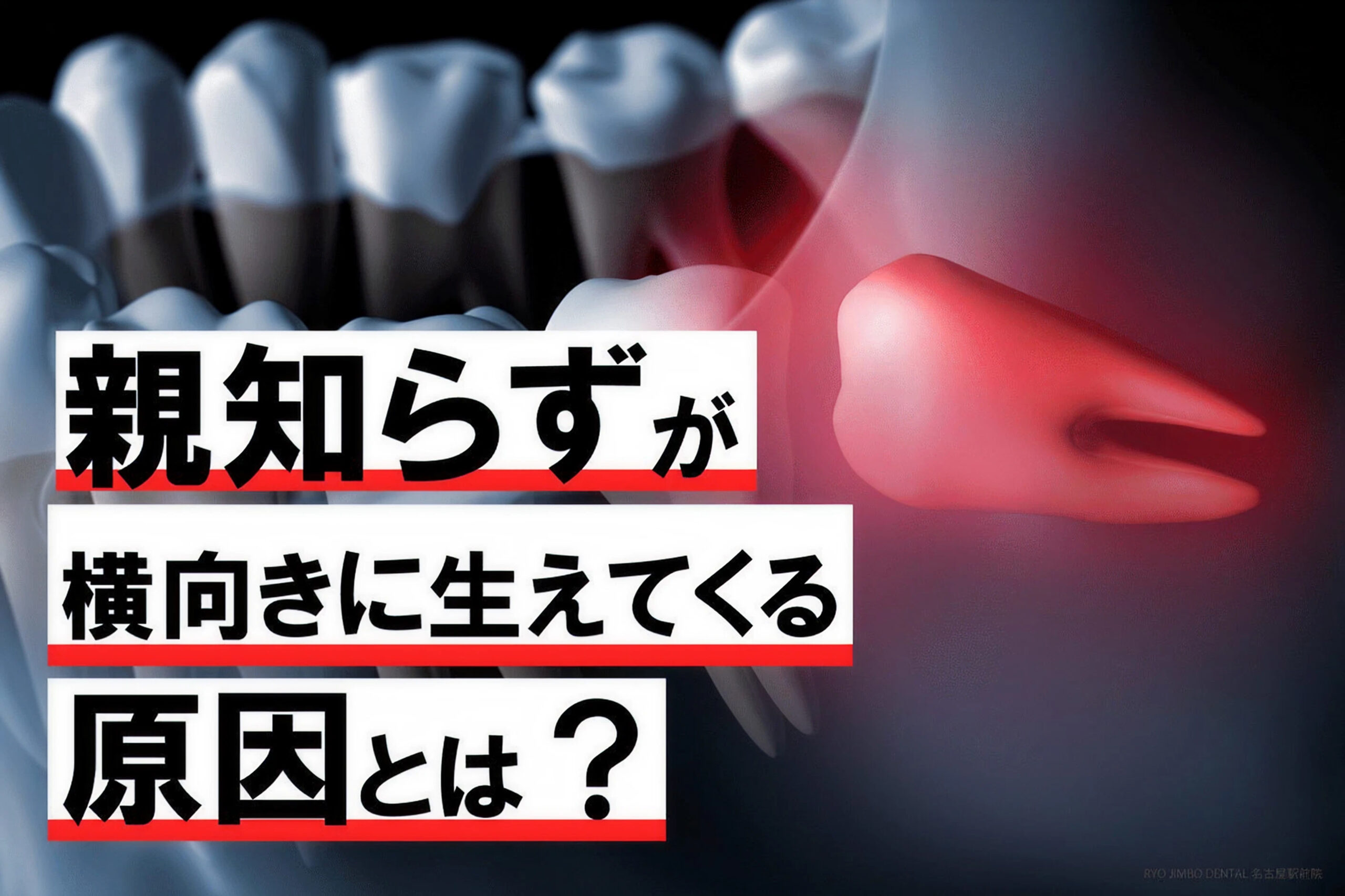 親知らずが横向きに生えてくる原因とは？虫歯や歯並びの悪化に要注意